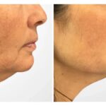 Best Plastic Surgeons in Dubai for Modern Anti Aging Thread Lift Treatment