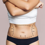 tummy-tuck-surgery-2