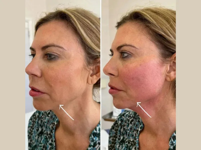 Best Doctors in dubai for Premium Endolift and Anti-Aging Care