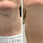 Best Plastic Surgeon in dubai for RF Microneedling Skin Tightening