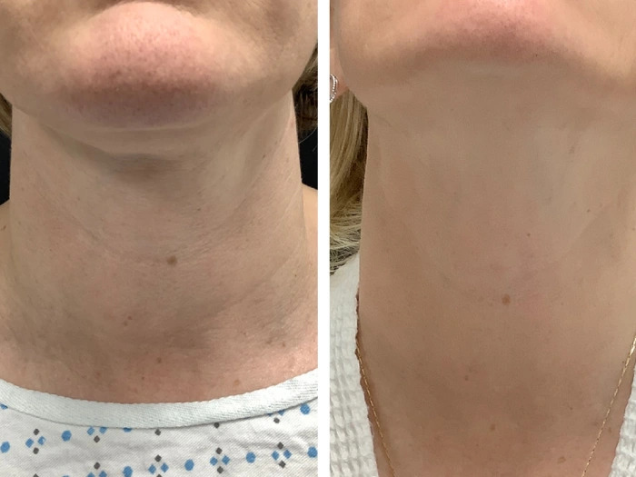 Best Plastic Surgeon in dubai for RF Microneedling Skin Tightening