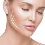 endolift