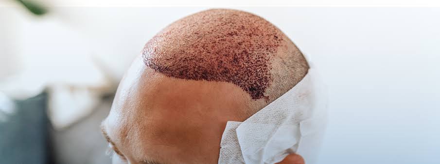 hair transplant in dubai