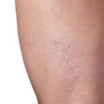 Spider Veins Treatment In Dubai