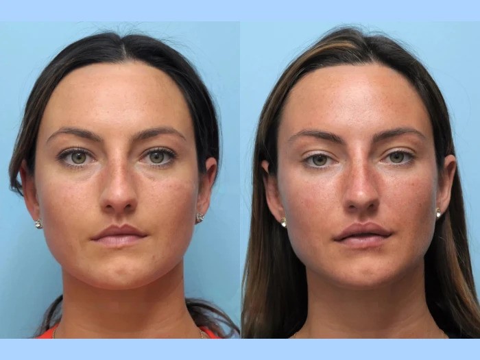 Effective Thread Lift Treatments in Dubai Improving Collagen Production and Firmness