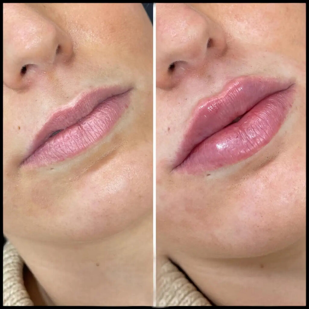 fillers