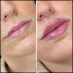 fillers