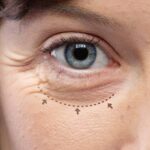Lower Blepharoplasty In Dubai