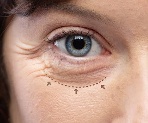 Lower Blepharoplasty In Dubai