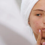 Acne Scar Removal-in Dubai