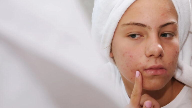 Acne Scar Removal-in Dubai