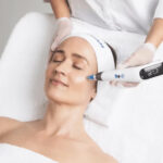 microneedling Edmonton