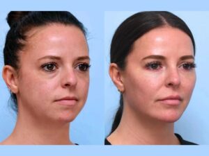 Best Plastic Surgeons in Dubai for Elegant Natural-Looking Thread Lift Results