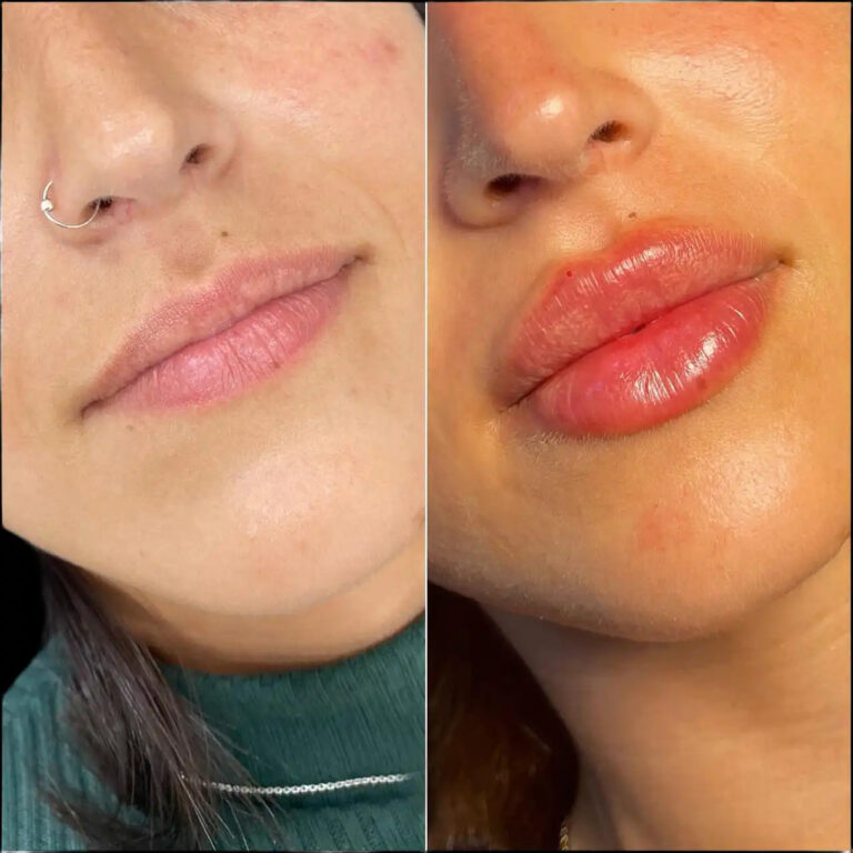 dermal fillers in dubai