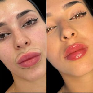 Dermal Fillers Injection in Dubai