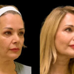 Cheek Fillers Injection In Dubai