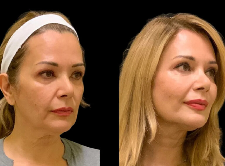 Cheek Fillers Injection In Dubai