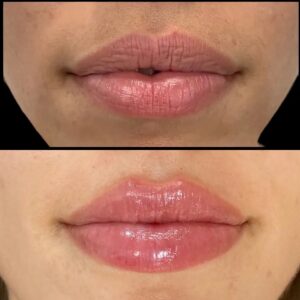 Fillers Injection in Dubai