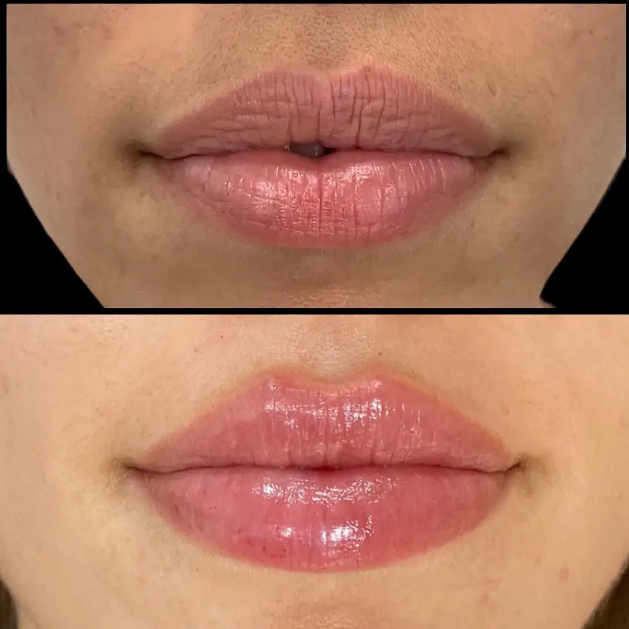 Fillers Injection in Dubai