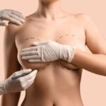 breast augmentation