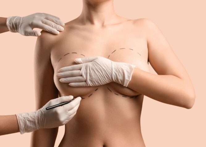 breast augmentation