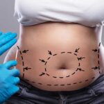 tummy-tuck-in-dubai