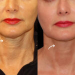 sculptra fillers in dubai
