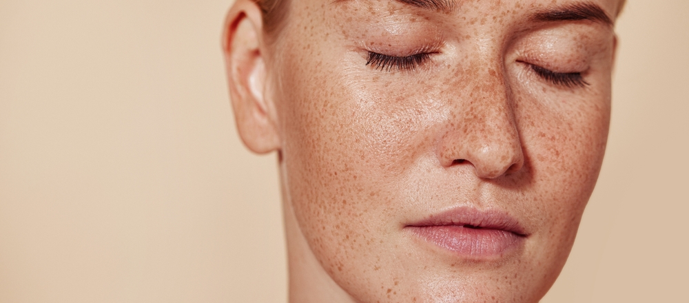 Pigmentation Treatment in Dubai: Treating Uneven Skin Tone and Dark Spots